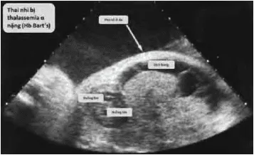Thai phù trong hội chứng Bart