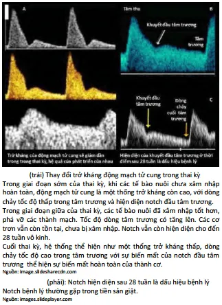Thay đổi của Doppler động mạch tử cung