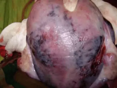 Tử cung Couvelaire