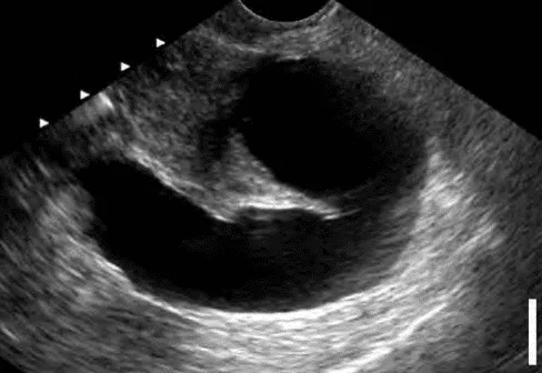 Vòi Fallope ứ dịch trên siêu âm