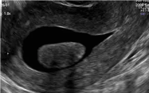 U xơ tử cung FIGO 0 trên SIS