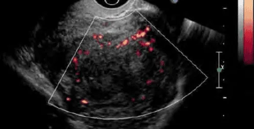 U xơ tử cung trên siêu âm Doppler