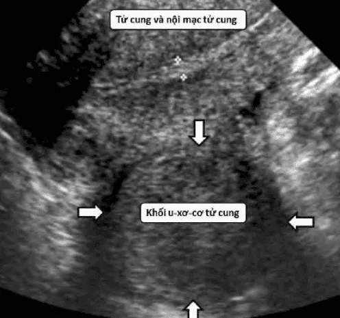 U xơ tử cung trên siêu âm