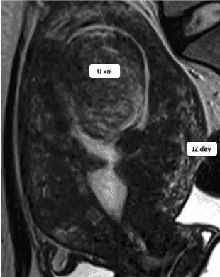 Kết hợp adenomyosis và u xơ tử cung