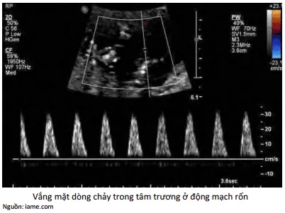 Vắng mặt dòng chảy trong tâm trương động mạch rốn