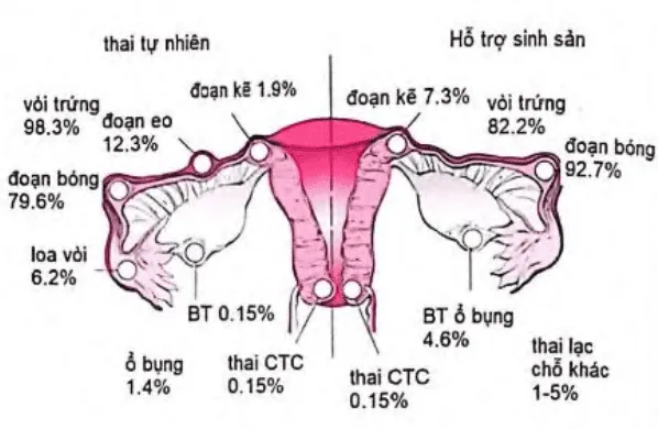 Các vị trí chửa ngoài tử cung