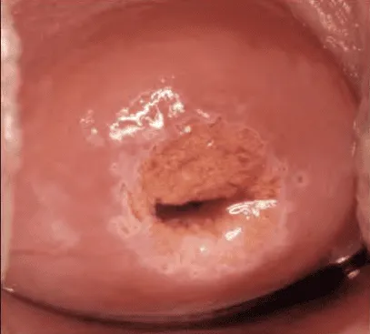 Vùng chuyển sản sau điều trị